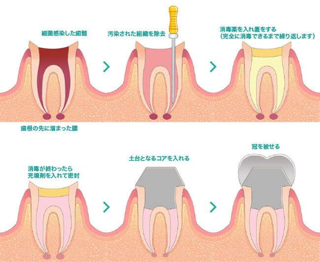 歯内療法・根管治療の流れ
