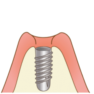 インプラントのイメージ