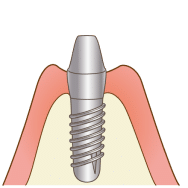 インプラントのイメージ