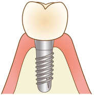 インプラントのイメージ