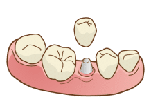 インプラント