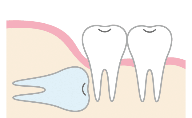 親知らずのタイプ③水平に埋没している場合
